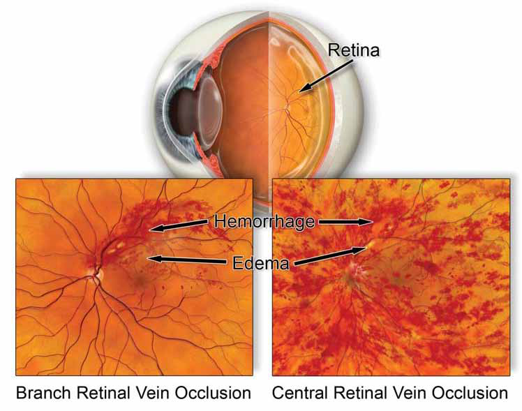 RetinalVeinOcclusion