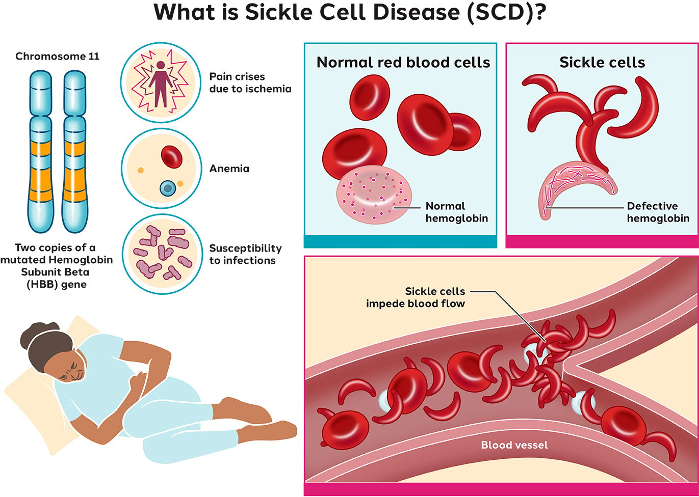 Sickle Cell