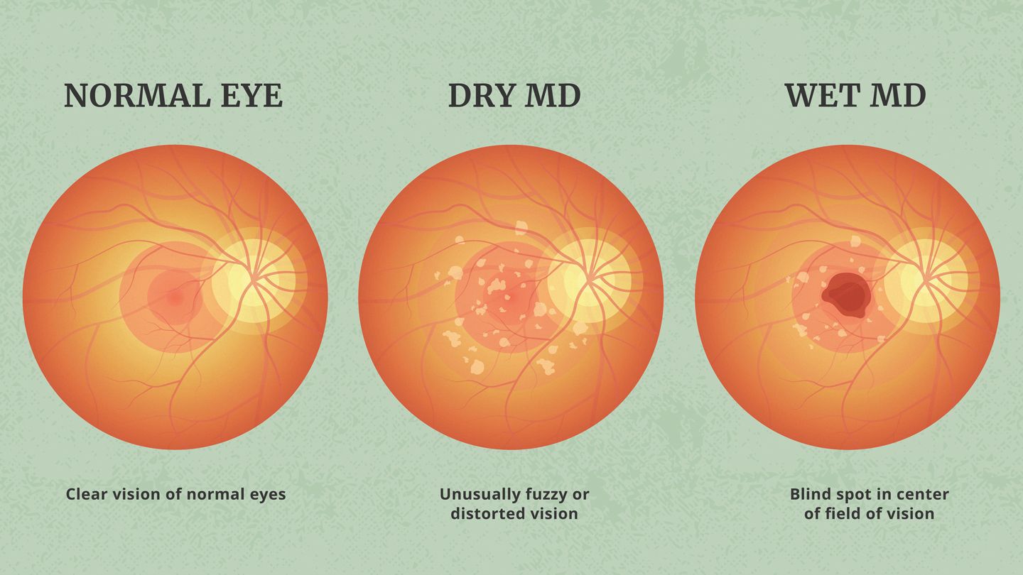 macular degeneration