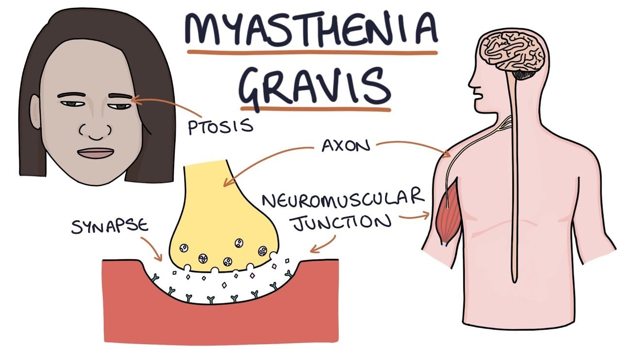 myasthenia gravis