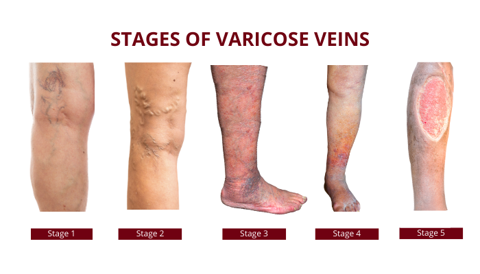 varicose veins